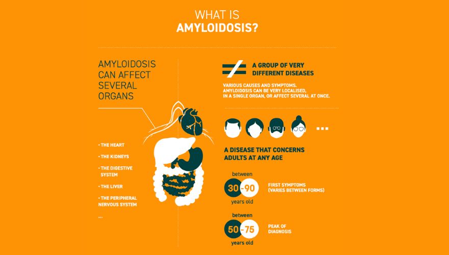 The Amyloidosis infographic